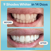 Before and after comparison of teeth whitening with text '9 Shades Whiter in 14 Days' on a blue background.